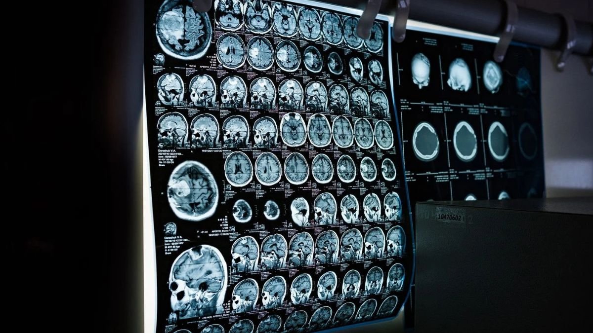 Alerte Sanitaire en Angleterre : Une Épidémie de Méningite Fait Deux Morts et Plusieurs Cas Graves Liés à une Boîte de Nuit